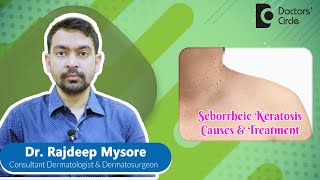 Black Warts on Face & Back|Removal of SEBORRHEIC KERATOSIS #skin  -Dr.Rajdeep Mysore|Doctors