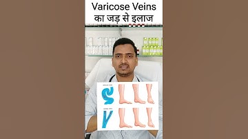 Varicose veins treatment without surgery |spider veins homeopathic treatment|varicose veins ka ilaj
