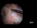 Réinsertion d'une rupture traumatique du tendon du sous scapulaire sous arthroscopie by SFI .