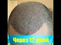 Пересадка волос 4100 графт | Гость из Казахстана