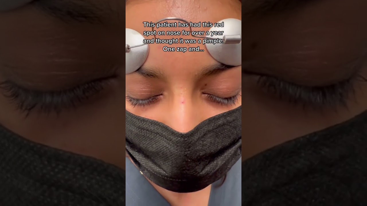 This is the laser you want if you have red spots, rosacea, blood vessels you want to target 