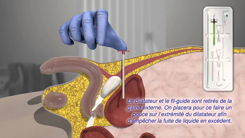 S-Cath®, Set de Drainage Vésical Sus-Pubien selon Seldinger avec ...