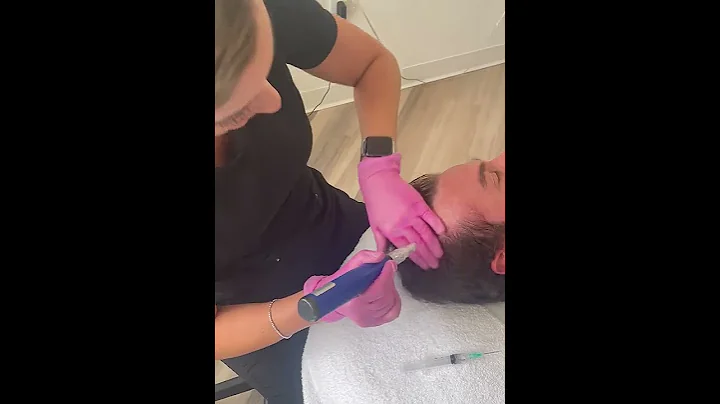 Microneedling with Exosomes on the scalp with Tara