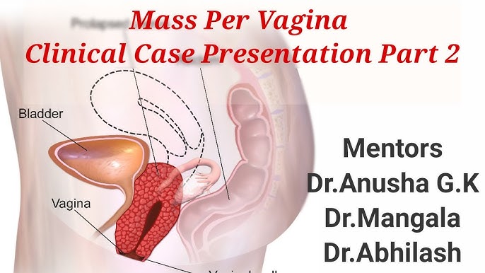 Pulsatsiyalanuvchi vaginal kesmalar