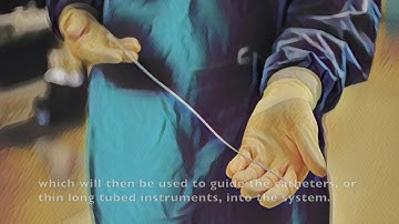 What to expect from IVC filter placement