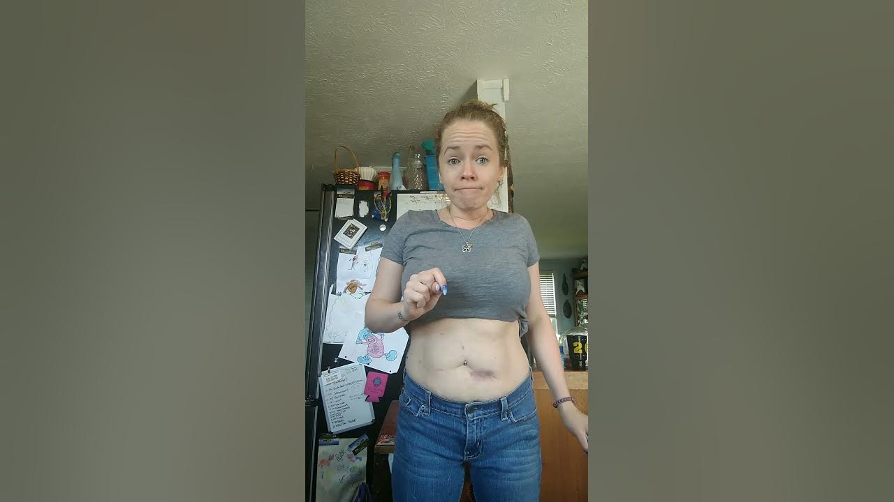 After having a reversal of an illestomy and colostomy bag. YouTube