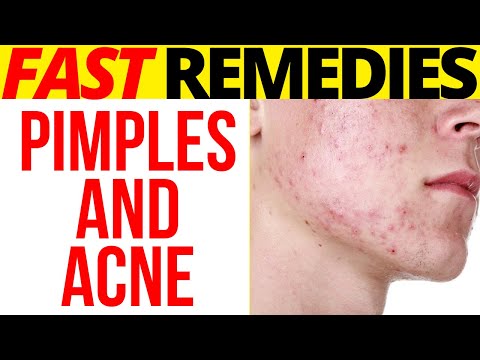 how-to-remove-pimple-marks-and-acne-scars-at-home:-9-remedies