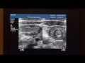 Intussusception Ultrasound short clip and image...