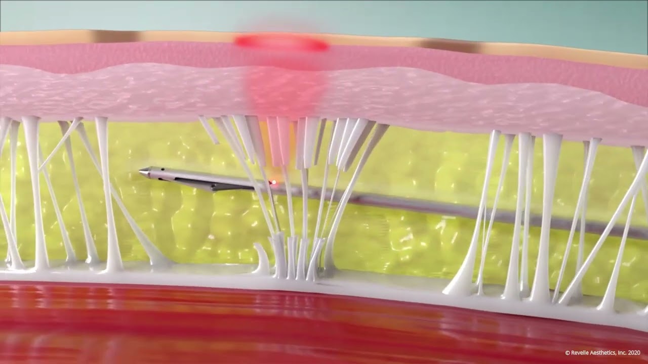 Aveli Cellulite Treatment Mechanism of Action, The Dermatology and Laser Group - NYC