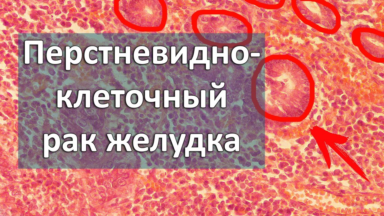 Перстневидно клеточный рак. Перстневидно клеточная карцинома. Перстневидно клеточная карцинома желудка. Перстневидные клетки в желудке. Перстневидно клеточная опухоль.