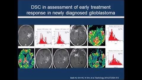 [Listen to Authors] Emerging Techniques in Brain Tumor Imaging: What Radiologists Need to Know