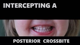 Intercepting a Posterior Crossbite
