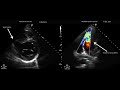 Ventricular Septal Rupture