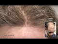 Hair Replacement fitting video (David) part 1 – Hair lnspira