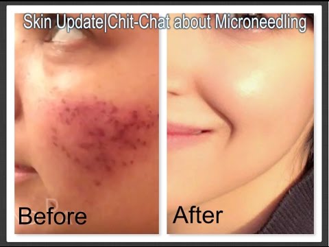 Microneedling Skin Update| Before &amp; After| Worth the Money ...