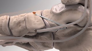 Flatfoot Repair with Arthrex® InternalBrace™ Augmentation