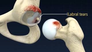 Hip Preservation
