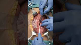 👶 Cesarean Section (C-Section)