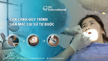 Cận Cảnh Quy Trình Gắn Mắc Cài Sứ Tự Buộc! Dr Cường