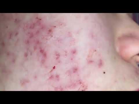 (AMAZING) !!! BEST BLACKHEAD REMOVE AND CYSTIC  REMOVE ON FACE (PART )