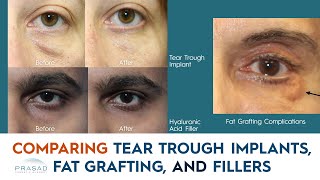 Under Eye Hollows  Comparing Under Eye Filler, Tear Trough Implants, and Fat Grafting