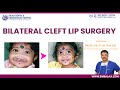 Bilateral Cleft Lip Surgery Video Bilateral Cleft Lip Correction Surgery New Video