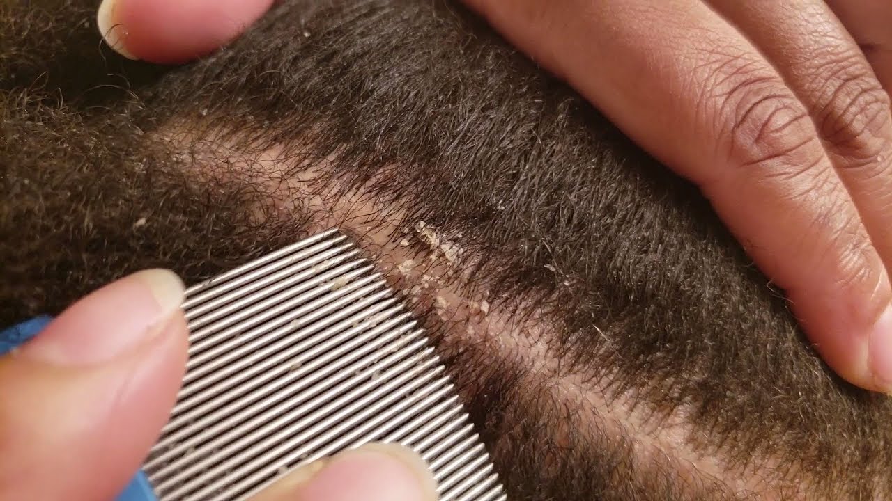 LITTLE FLAKES Dandruff Scratching Flaky Scalp 