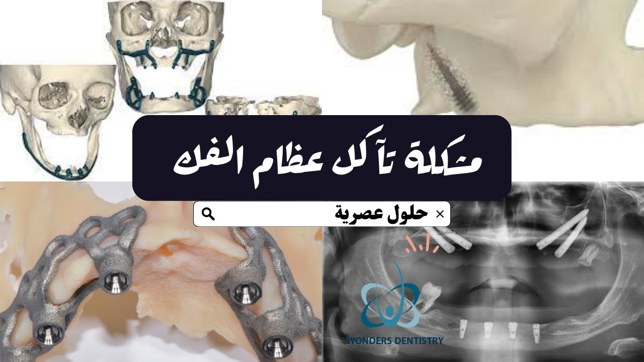 حلول لمشكلة فقدان عظم الفك بدون زراعة عظم
