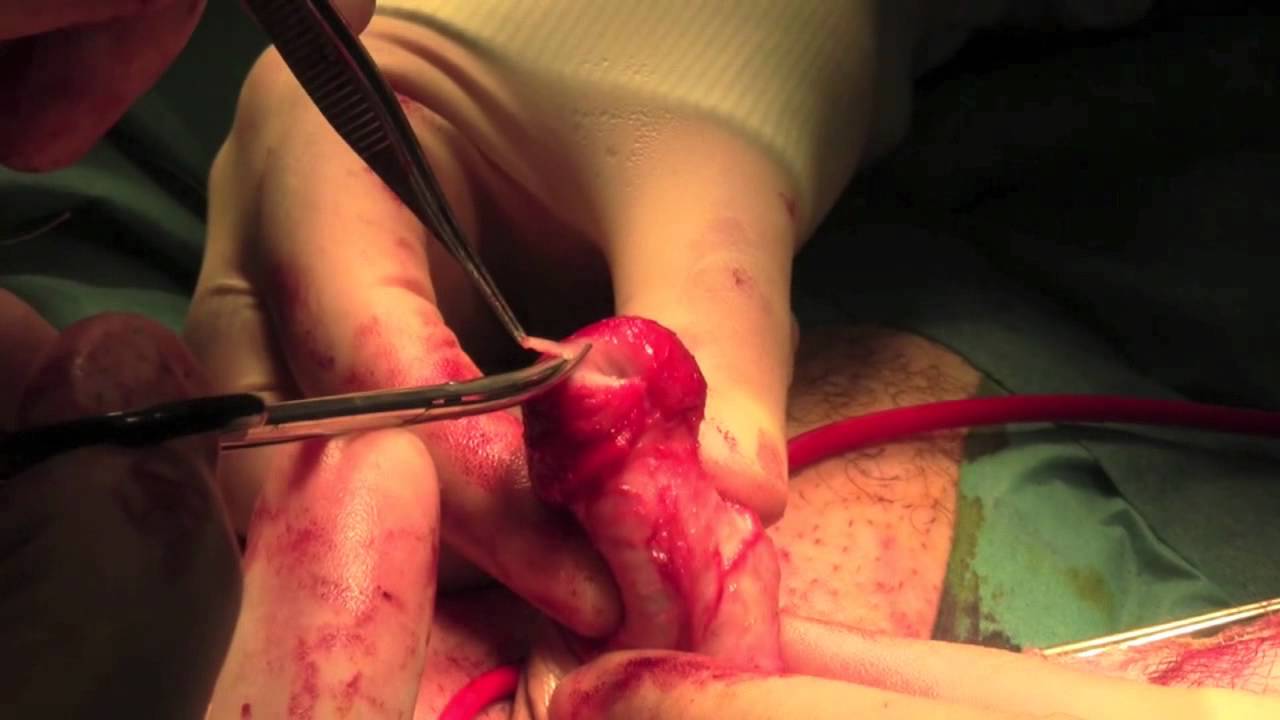 Glansectomy Pics