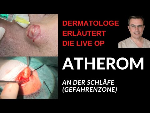 Video: Atherom Am Ohrläppchen Oder Dahinter Bei Einem Kind