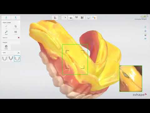 3Shape TRIOS Edentulous patient    Copy denture scanning workflow