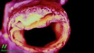 How To Help Prevent Abdominal Aortic Aneurysms