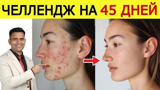 ИЗБАВЬТЕ СЕБЯ ОТ ПРЫЩЕЙ.