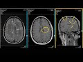 ADC Positive Multiple Sclerosis - Demyelination MRI Case Review