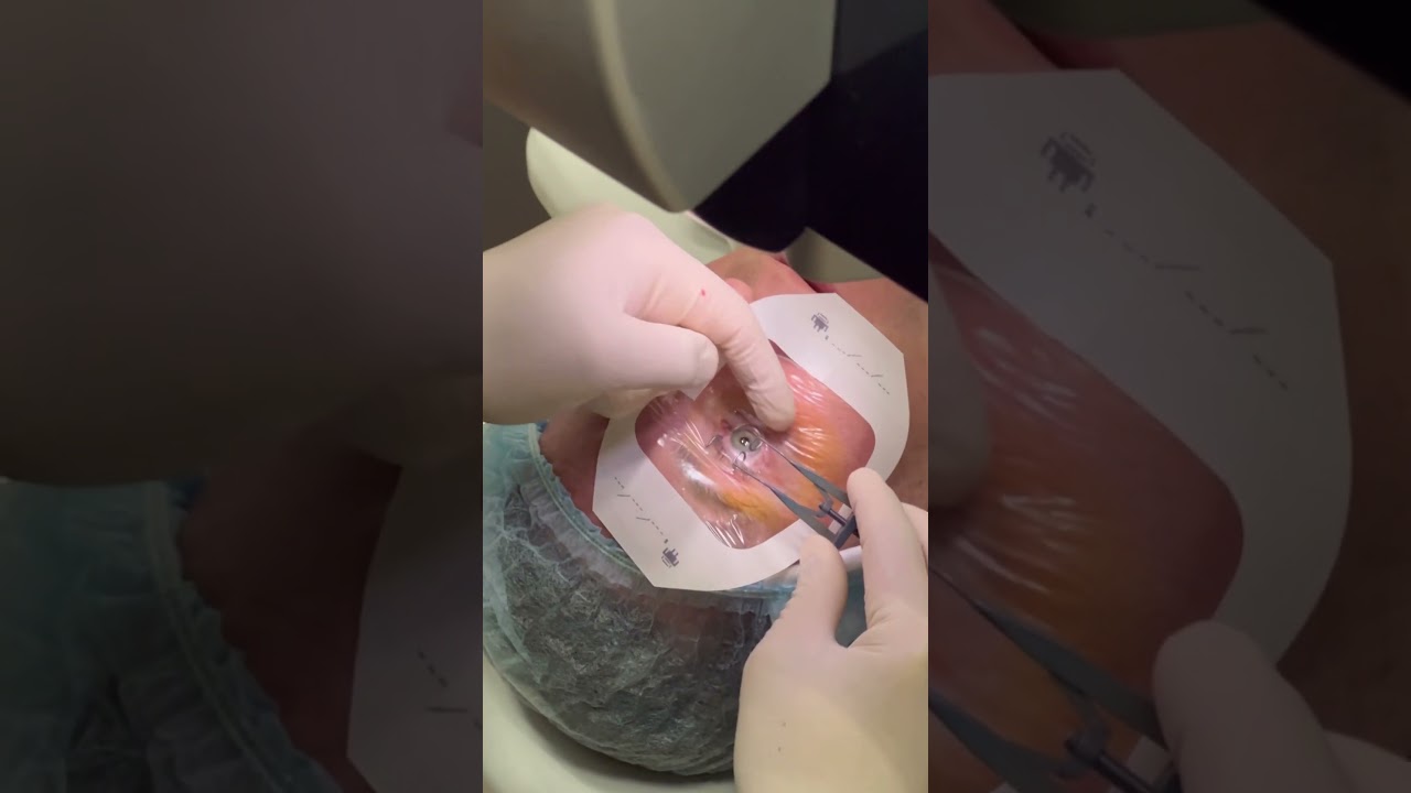 There is NO PAIN DURING LASIK