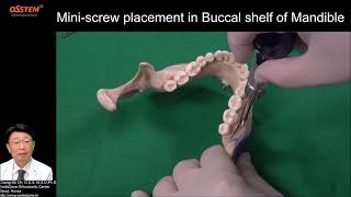 8  Buccal Shelf When and How to use  Orthodontic Screw