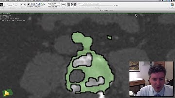 Segmentação aórtica