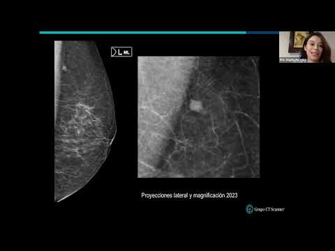 Sesión mensual dela Unidad de Imagen Mamaria, revisión de casos impartido por CT Scanner Lomas Altas
