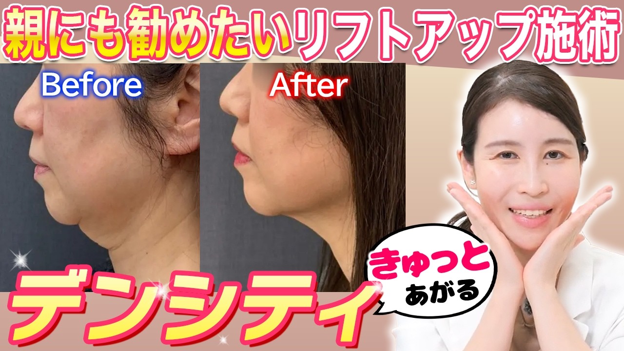 【切らないリフトアップ】デンシティで劇的若見え！5つの症例で徹底解説【即時×持続の肌育】
