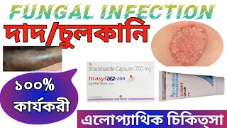 Fungal Infection হওয়ার কারণ কি | দাদ চুলকানির এলোপ্যাথিক চিকিৎসা।