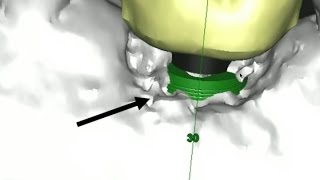 How to plan the PERFECT implant?