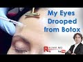 My Eyes Drooped after Botox-Dr Rajani