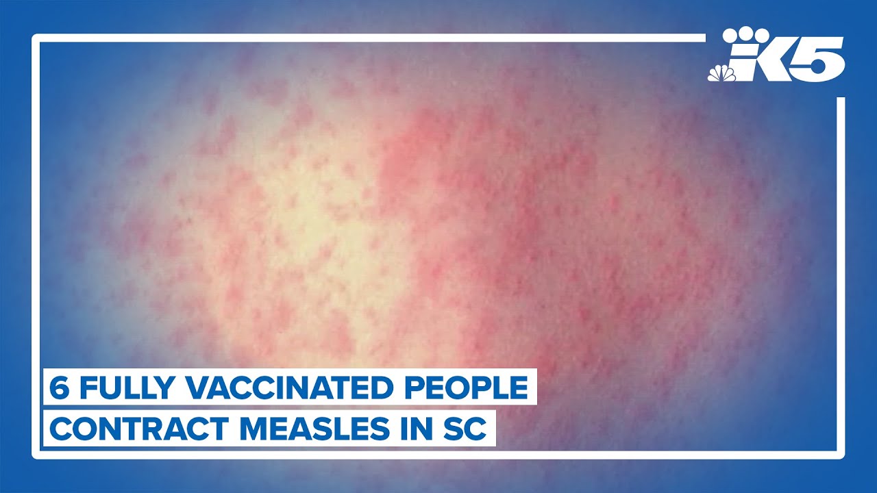 6 fully vaccinated people infected with measles in South Carolina outbreak