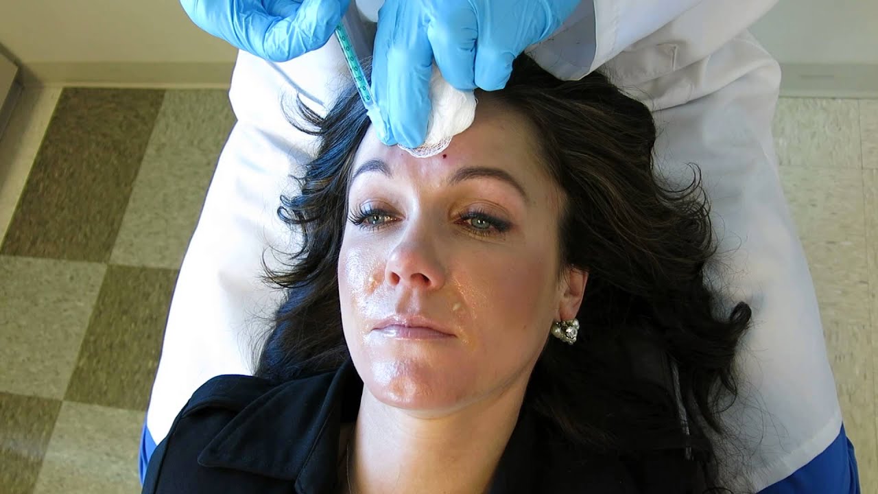 Botox Injection by THE BEST Facial Plastic Surgeon in Utah! YouTube