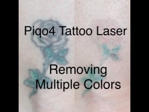 PiQo4 Tattoo Removal  Pigmentation Correction  Peraza Dermatology Group