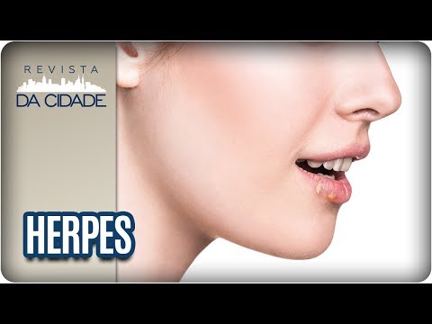 Vídeo: Como é O Herpes? Sinais E Sintomas