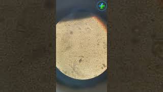 Cystine Crystals In Urine Crystals In Urine Urine Microscopic Examination