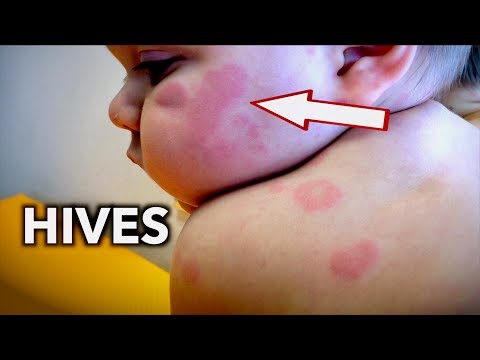 Video: Hives On Baby: Orsaker, Behandling, När Man Ska Ringa Läkaren & Mer
