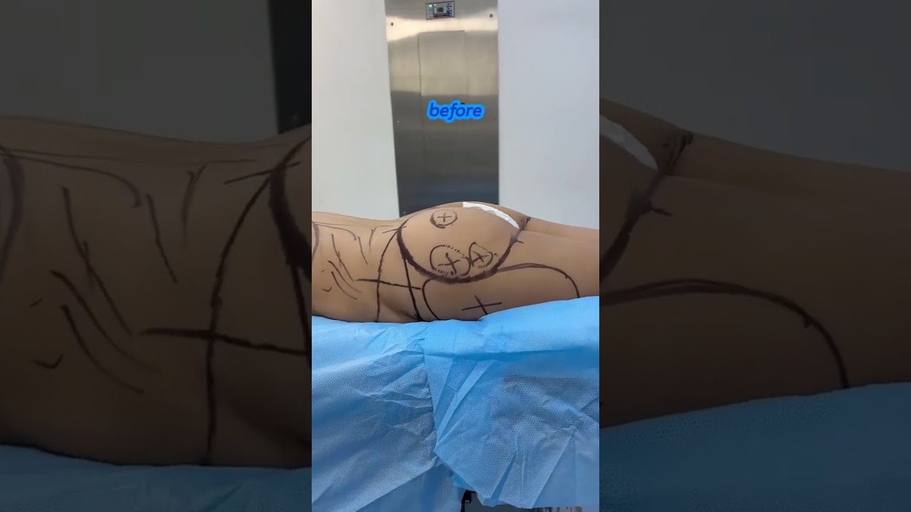 Video: BBL before and after results
