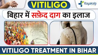 बिहार में सफ़ेद दाग का इलाज  | Vitiligo Treatment in Patna (Bihar) | Doctors for Vitiligo in Patna